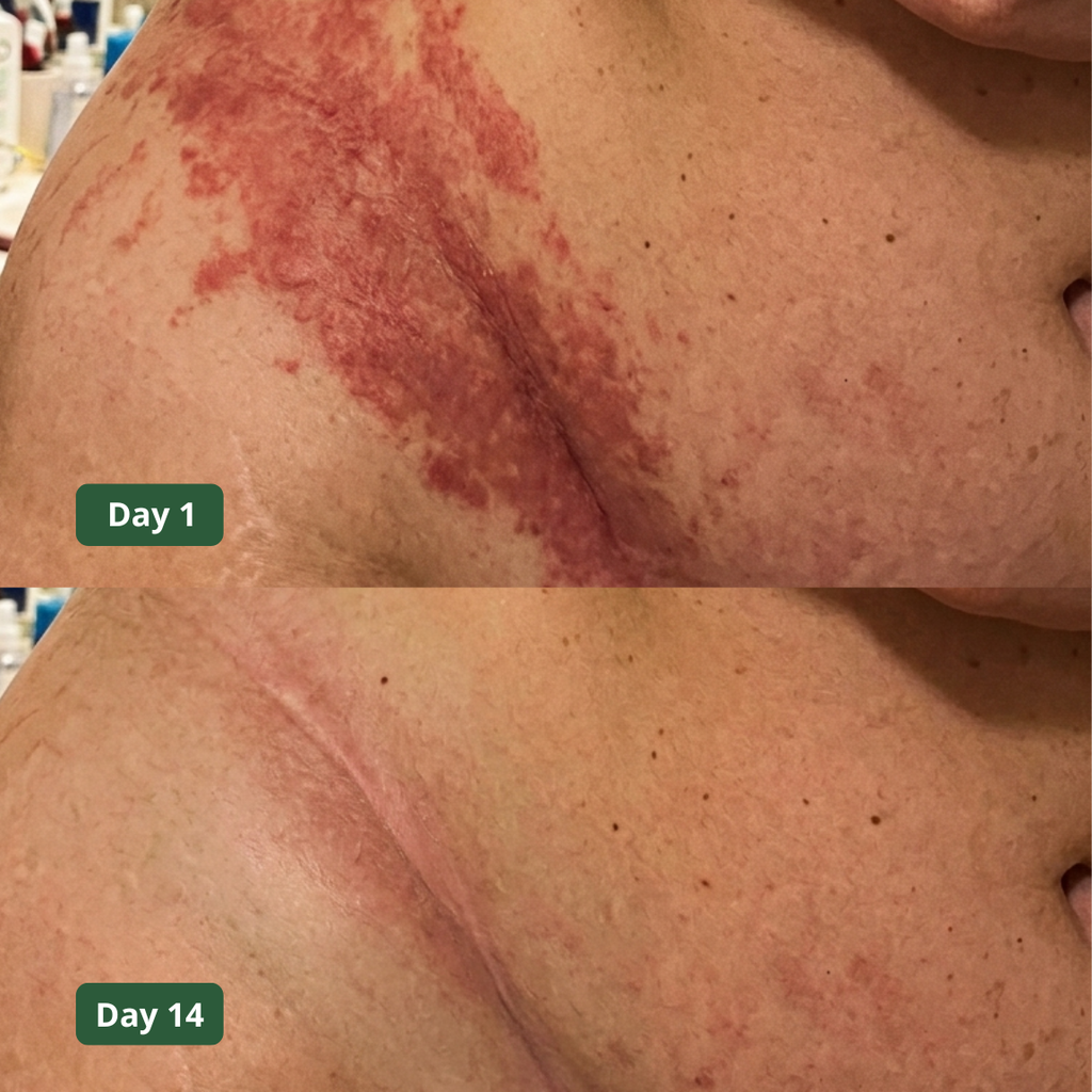 Intertrigo Relief Cream